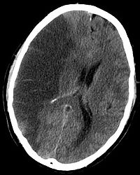 Ось так виглядає ішемічний інсульт на рентгенівському фото. Темна пляма - це зона, до якої неможе потрапити кров через тромб у судині