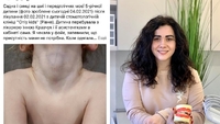 Після прийому у стоматолога 5-річна дівчинка вийшла із синцями на шиї. Лікарка відповіла на звинувачення