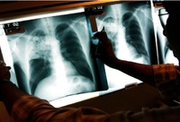 Мешканці яких районів Рівненщини найбільш вразливі до туберкульозу