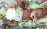 Відомий кардіохірург подякував лікарям з Рівненщини за врятованого малюка, який важив 800 грамів (ВІДЕО)