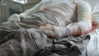 Отримали опіки під час заправки бензокоси: на Рівненщині двоє людей у лікарні