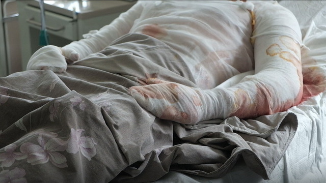 Отримали опіки під час заправки бензокоси: на Рівненщині двоє людей у лікарні