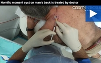 Лікар зняв на камеру процес видалення великої ліпоми (кісти) на спині у пацієнта (Відео 18+)