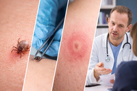 Захистіть себе від хвороби Лайма: лікар пояснив, що потрібно робити українцям при укусі кліща 