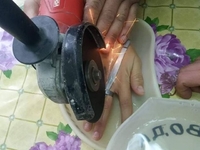 Кадри не для слабодухих: підлітку болгаркою розрізали перстень на пальці (ФОТО)