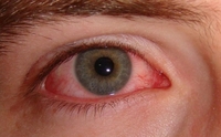 Лікарі вийняли з ока пацієнта 12-сантиметрового гельмінта за 75 км від м. Рівне (ФОТО 18+)