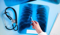 Як хворим на туберкульоз переселенцям отримати медичну допомогу на Рівненщині