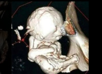 В утробі жінки знайшли плід «кам'яної дитини», який вона виношувала 35 років (ФОТО)