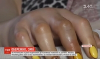 ТСН показала, як виглядає розпухла після укусу гадюки рука дівчини на Рівненщині (ФОТО/ВІДЕО)