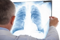 У Рівному планують покращити діагностику туберкульозу 