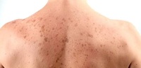 Вікові пігментні плями на шкірі: безпечний та дієвий метод їх позбутися
