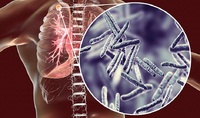 На Рівненщині туберкульоз можуть виявити усього за 77 хвилин