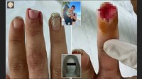 Росіянка відкусила пальця жінці в Таїланді: не хотіла віддавати вільну лежанку на пляжі (ФОТО)