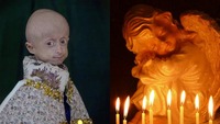 Унікальна українська дівчинка з рідкісною хворобою померла: за нею стежила вся країна