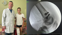 Зібрали кістку по частинках: у Рівному 13-річному підлітку провели надскладну операцію (ФОТО)