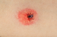 Сезон кліщів: як не підхопити хворобу Лайма та що потрібно знати