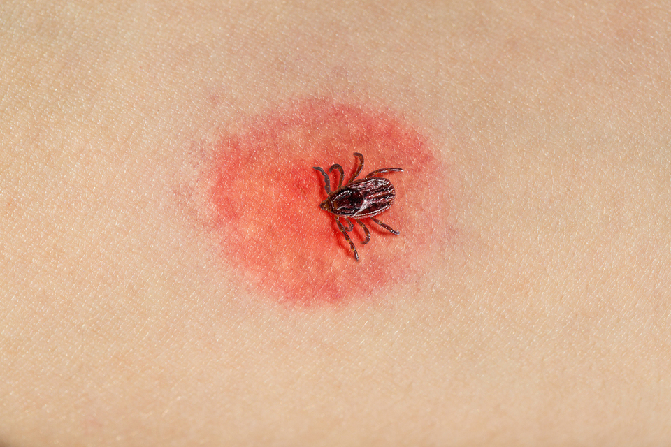 Сезон кліщів: як не підхопити хворобу Лайма та що потрібно знати