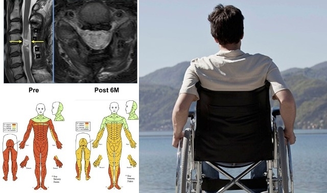 Ліворуч показано динаміку відновлення чутливості та моторики м'язів тіла в одного з пацієнтів