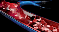 Ризик тромбів: чому кров раптово стає густою