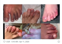 «Коронавірусні ноги» — новий симптом COVID-19 на шкірі?